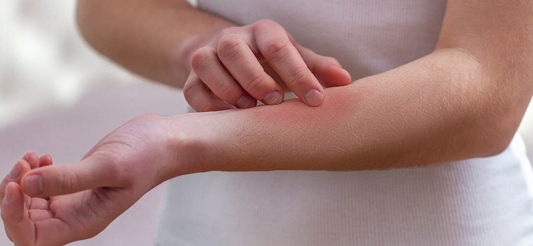 Would you know what to do if a child is stung?