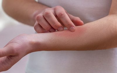 Would you know what to do if a child is stung?