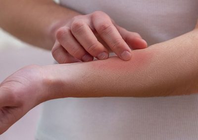 Would you know what to do if a child is stung?