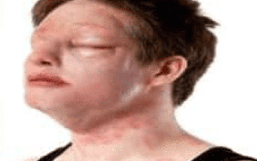 Level 2 Basic Life Support and Management of Anaphylaxsis (QCF)