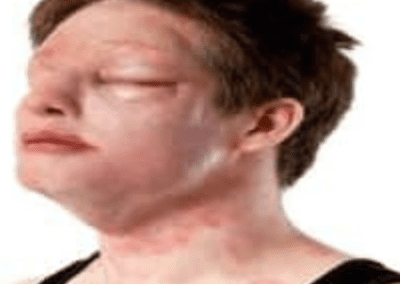 Level 2 Basic Life Support and Management of Anaphylaxsis (QCF)