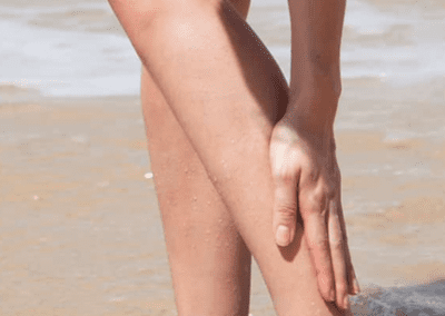 Stings from sea creatures