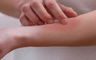 Bites & Stings
